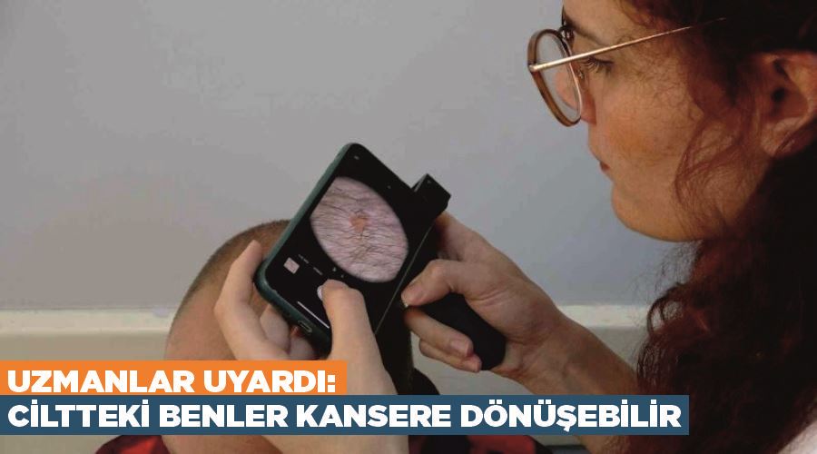 Uzmanlar uyardı: Ciltteki benler kansere dönüşebilir