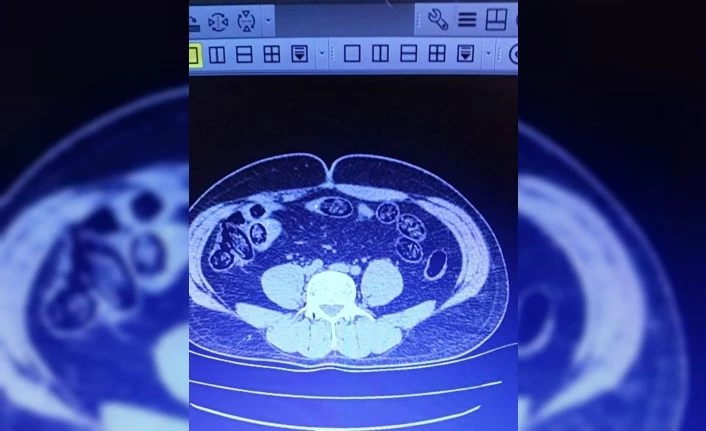 Uçağa binmek isteyen 2 İranlının midesinden 103 kapsül uyuşturucu çıktı